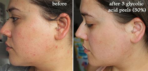 how many glycolic peels to see results